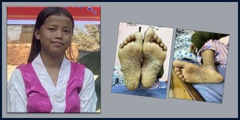 नुवाकोट पञ्चकन्याकी छाला रोगपीडित सुनिताको उपचारका लागि सहयोग संकलन